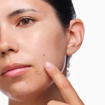 rdn-the-acne-set-application.webp